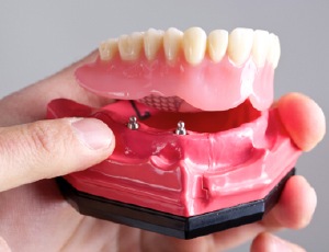 Model All-on-4 denture