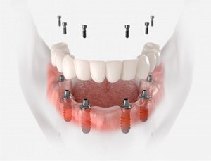 a 3D depiction of an implant denture