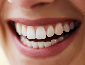 Closeup flawless smile with direct bonding
