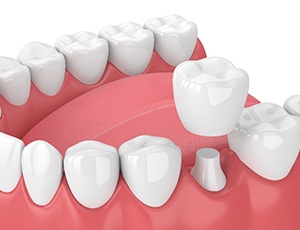 Illustration of dental crown being placed on bottom tooth