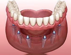 Digital illustration of implant dentures