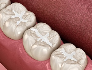 Digital image of three teeth with dental fillings