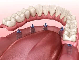 Diagram of implant dentures in Harrisburg
