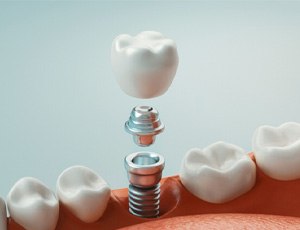 A 3D illustration of a single-tooth dental implant