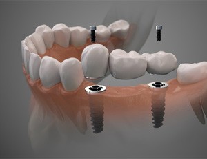 3D illustration of an implant bridge