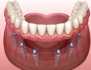 A 3D illustration of an implant denture