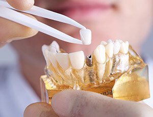 dentist placing a crown on a model of a dental implant