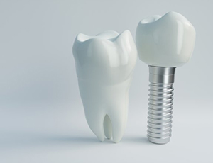 dental implant with crown next to a natural tooth 