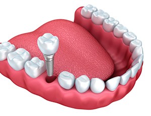 dental implant being placed in the lower jaw 