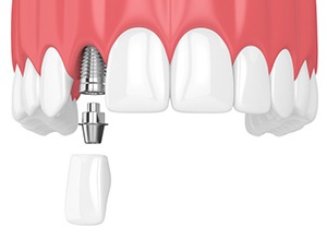 model of how dental implants in Harrisburg work 