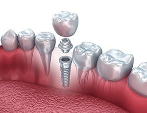 dental implant with abutment and crown