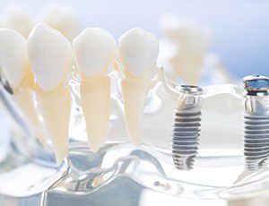 two dental implant posts that will support a dental bridge 