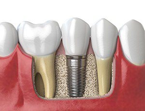 dental implant fusing to the jawbone