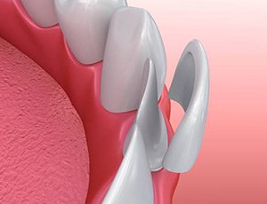 model of veneers