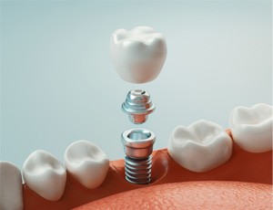 an example of a dental implant in Harrisburg