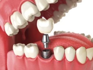 representation of dental implant