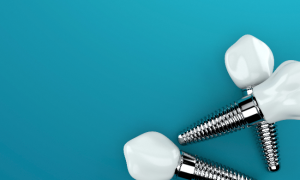 dental implants