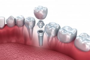 dental implant abutment crown gums