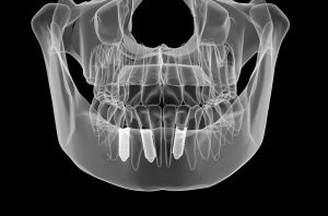 digital image of dental implants