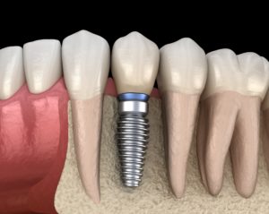 Image used to show the types of dental implants