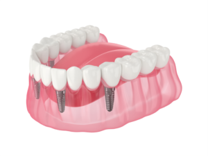 a graphic render of all-on-4 dental implants 