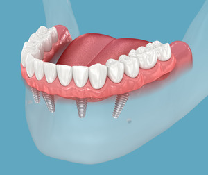 Illustration of All-on-4 for the lower jaw